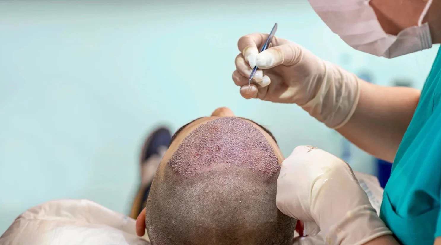 1686911894_hair-transplant hair replacement services in fairfax va